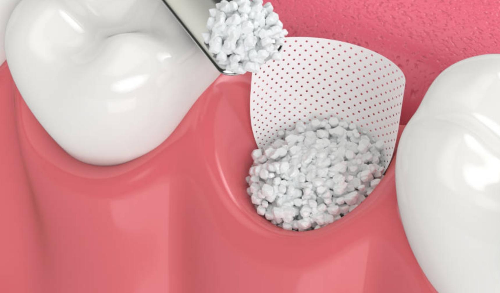 Preservación del hueso alveolar pos-extracción dental