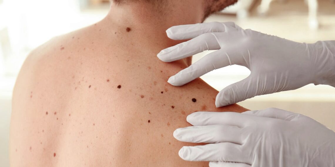 Lanzaron una campaña gratuita de revisión de lunares para prevenir el cáncer de piel