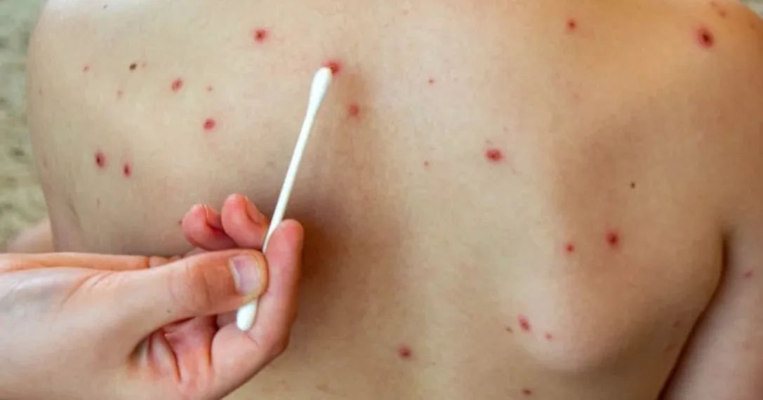 Viruela del mono: refuerzan controles de prevención y detección