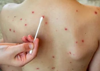 Viruela del mono: refuerzan controles de prevención y detección