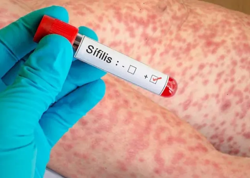Aumentaron los casos de sífilis: recomiendan acentuar en la prevención
