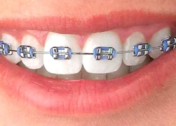 ORTODONCIA…¿Cómo sé si necesito tratamiento para corregir la posición de mis dientes o la de los niños?