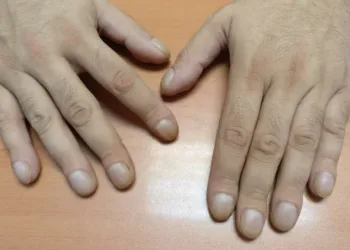 El extraño cambio en los dedos que puede alertar sobre uno de los cánceres más mortales