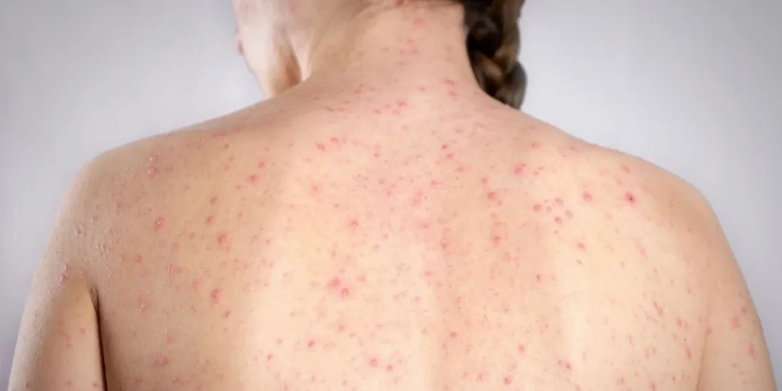 “¡Vacuná a tu hijo, ya!”: el desesperado ruego del Ministro de Salud