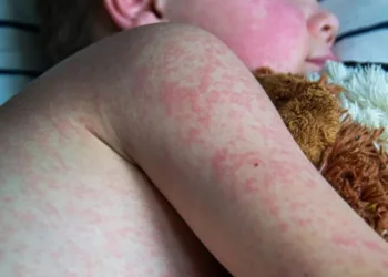 Sarampión: la SAP recordó la importancia de vacunar a los más chicos con la Doble y Triple viral