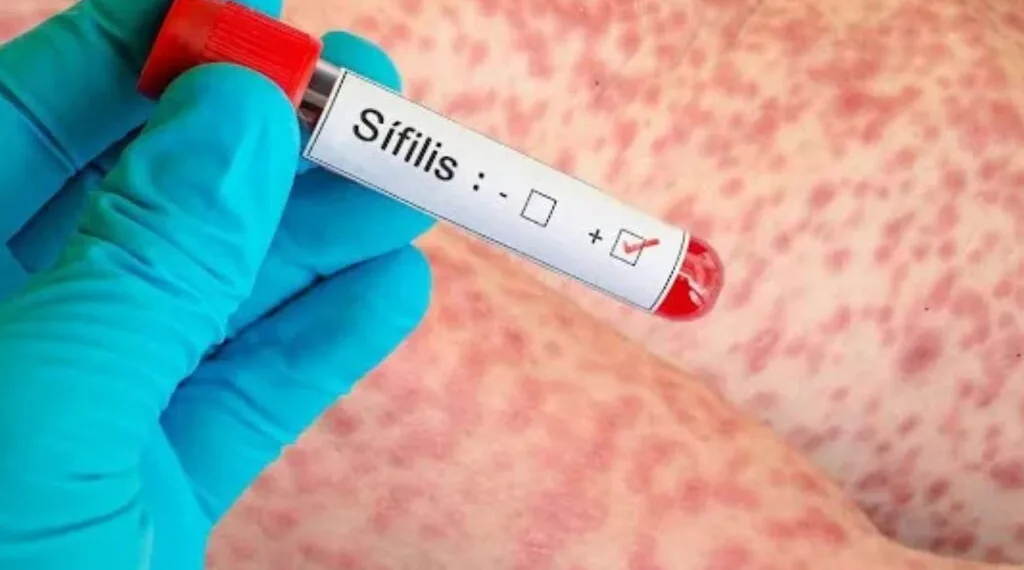 Sífilis: en Junín se diagnostican casos todas las semanas