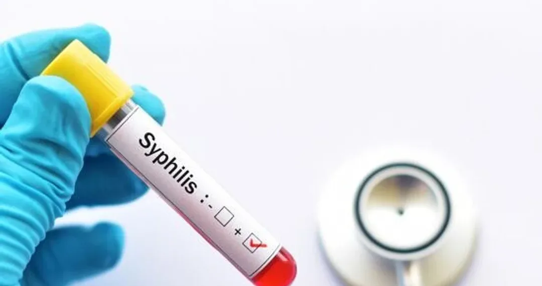 Alerta sífilis: los casos se incrementaron un 20,5% en Argentina