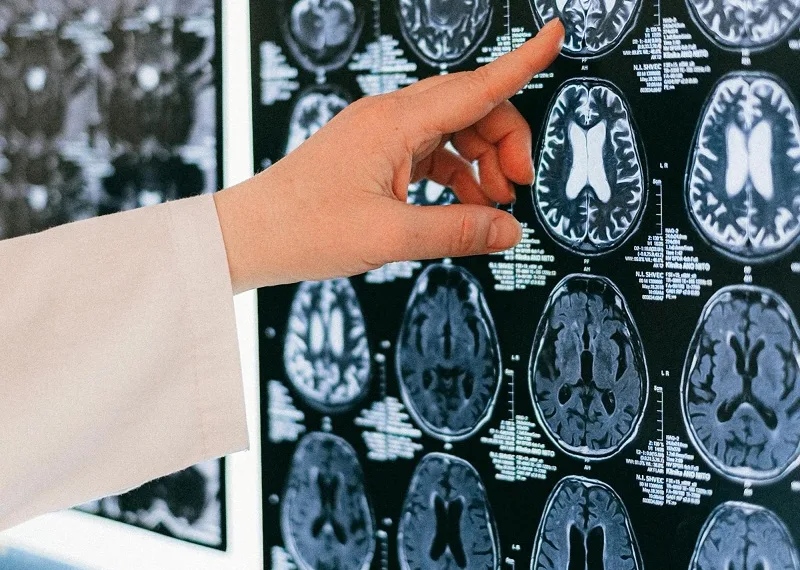 Logran revertir el Alzheimer en ratones con solo tres inyecciones de nanopartículas