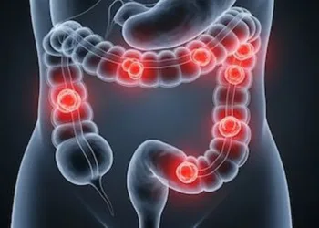 El Dr. Dulbecco dará una charla de concientización sobre el cáncer de colon en el MUMA