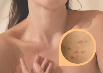 Tratamientos y consejos para las manchas en la piel