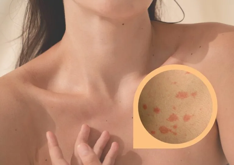 Tratamientos y consejos para las manchas en la piel