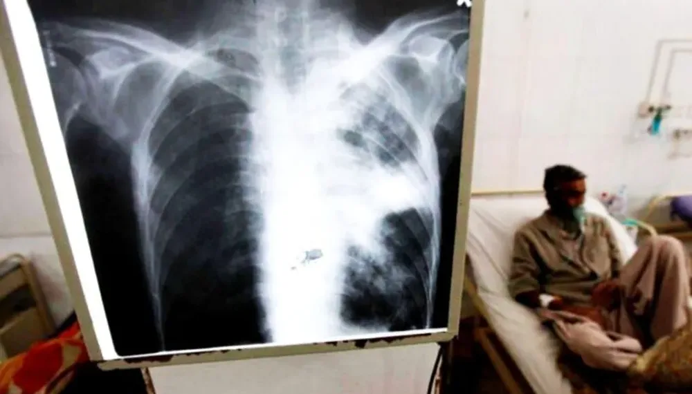 Mar del Plata: detectaron un caso de tuberculosis en un colegio y activaron el protocolo sanitario