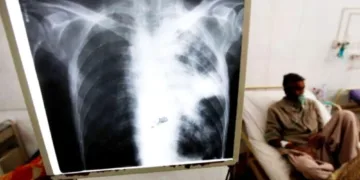 Mar del Plata: detectaron un caso de tuberculosis en un colegio y activaron el protocolo sanitario