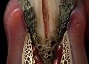 Prevalencia de las enfermedades gingivales