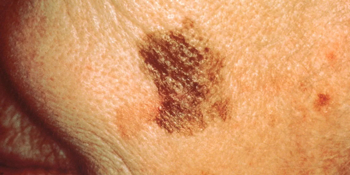 Melanoma: la importancia de conocer los síntomas y actuar preventivamente