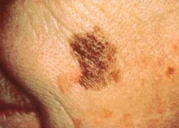 Melanoma: la importancia de conocer  los síntomas y actuar preventivamente