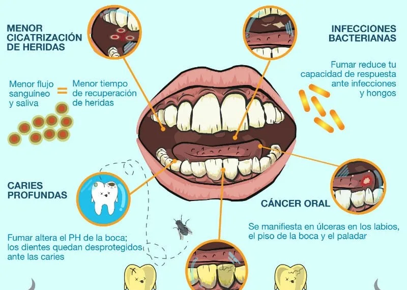 Tabaquismo, factor de riesgo esencial para la salud oral