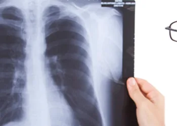 Tuberculosis: aumentan los casos debido a una mayor pobreza y desigualdades sociales