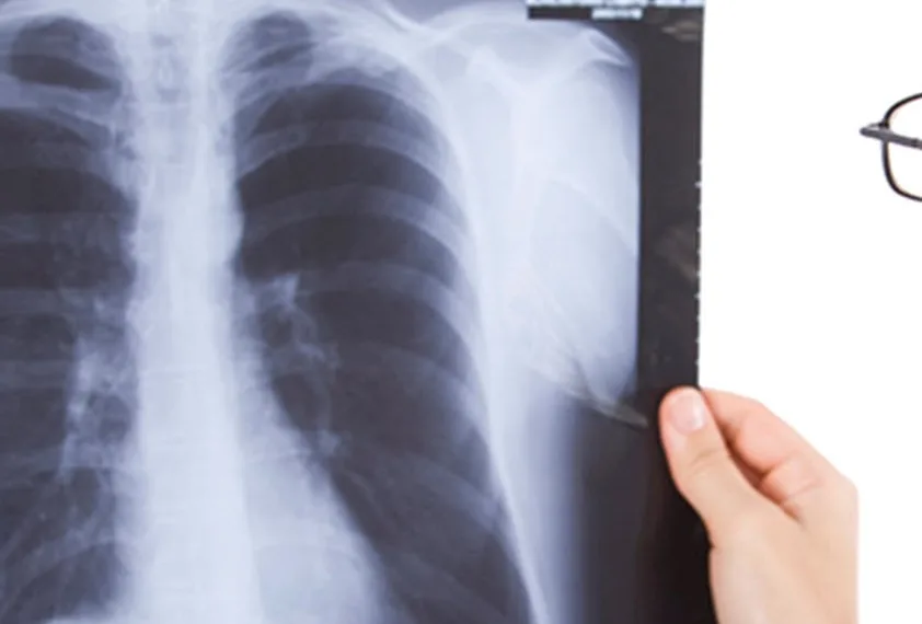 Tuberculosis: aumentan los casos debido a una mayor pobreza y desigualdades sociales